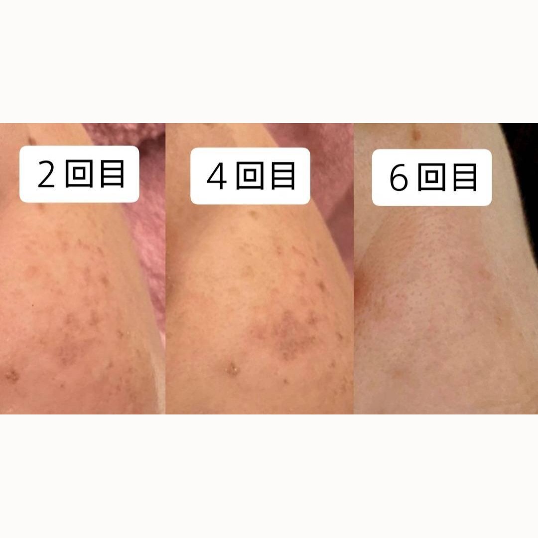 シミケア 2回目・4回目・6回目の経過